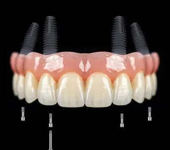 All-on-4 implants for full arch restoration