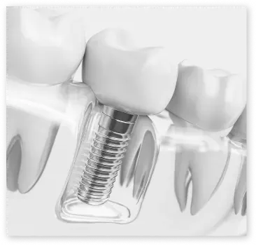 Dental implants to restore missing teeth