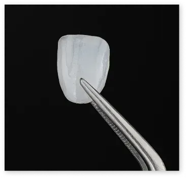 Dental veneers for a beautiful smile